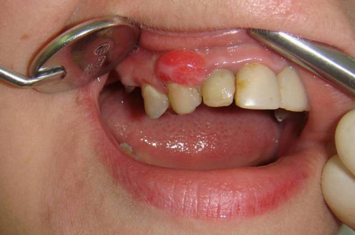 Что такое свищ зуба?