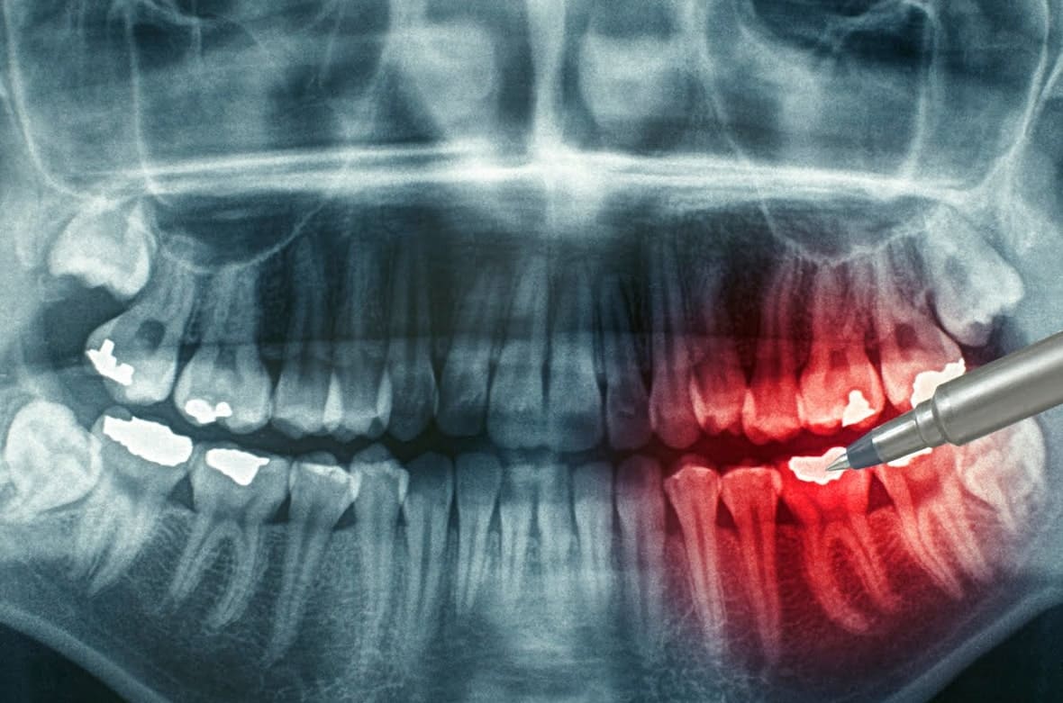 Почему ротовый сепсис нужно лечить только в клинике