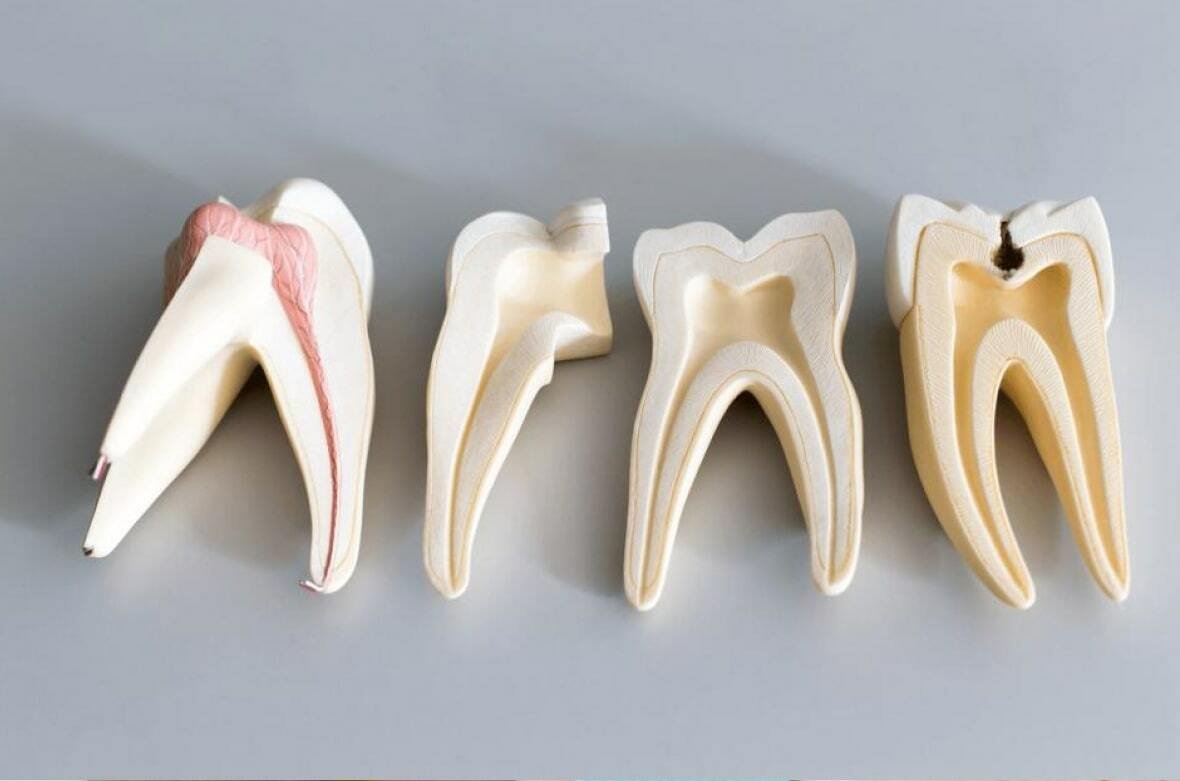 Причины непрорезывания зубов