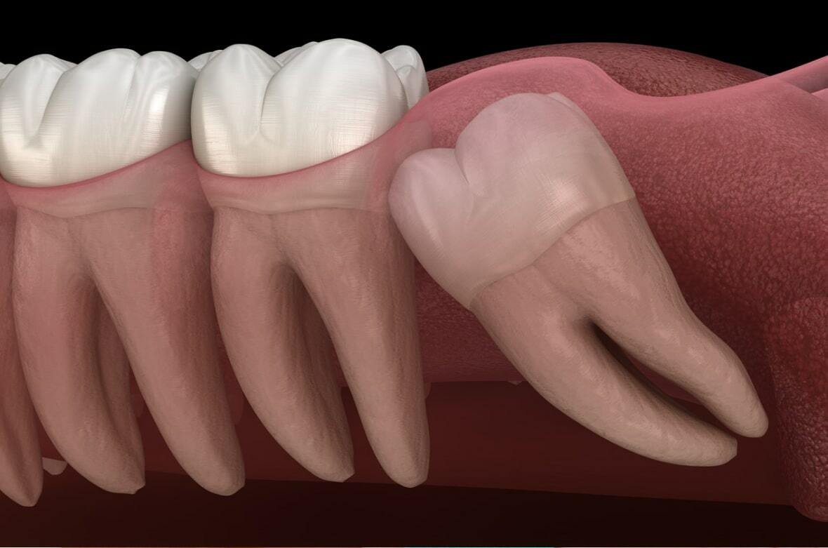 Ретенция в ортодонтии