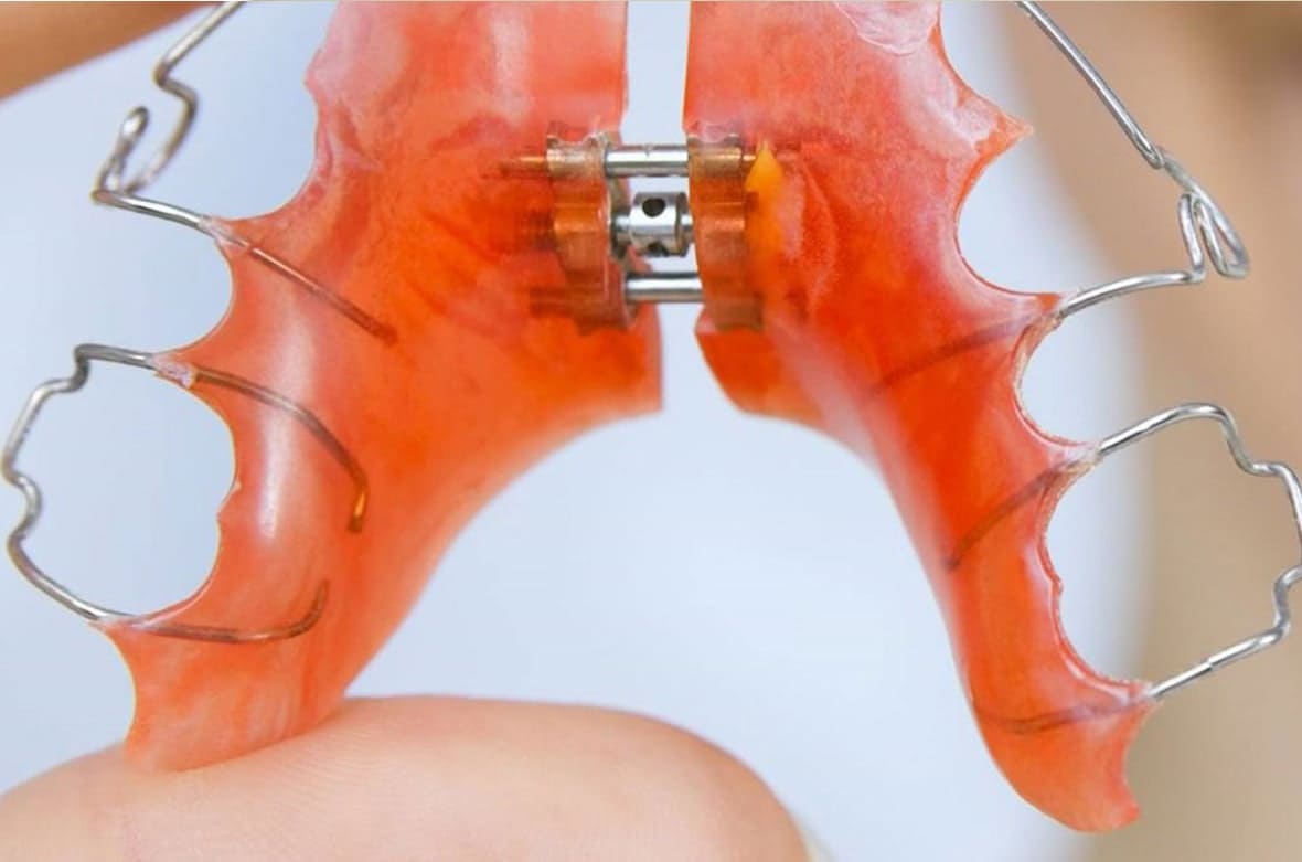 Ортодонтические пластинки – что это такое