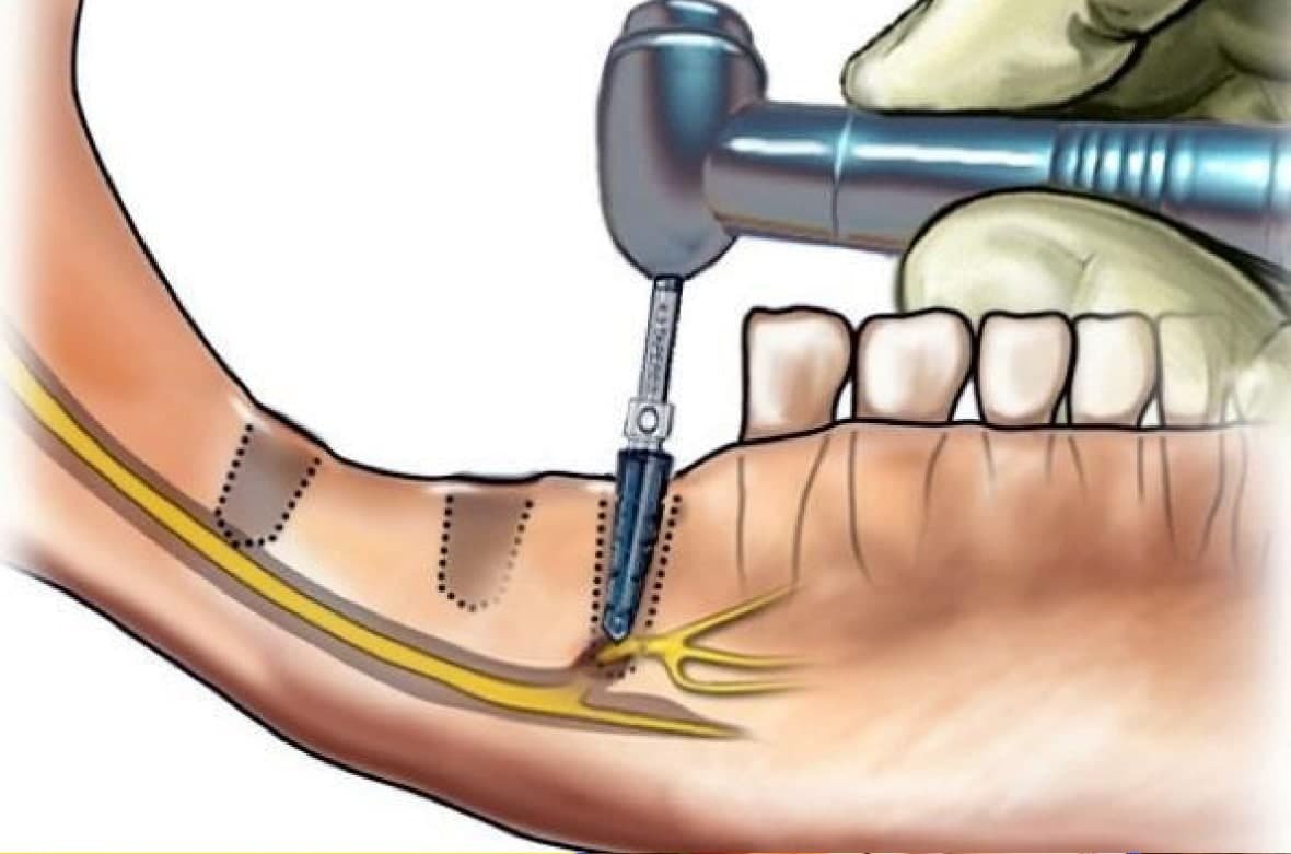 Чи може боліти трійчастий нерв від зуба?