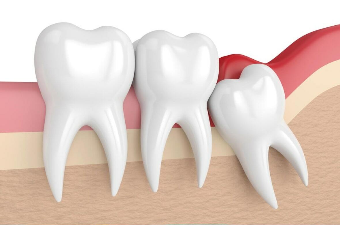 Ретенция зубов – когда нужно лечить?