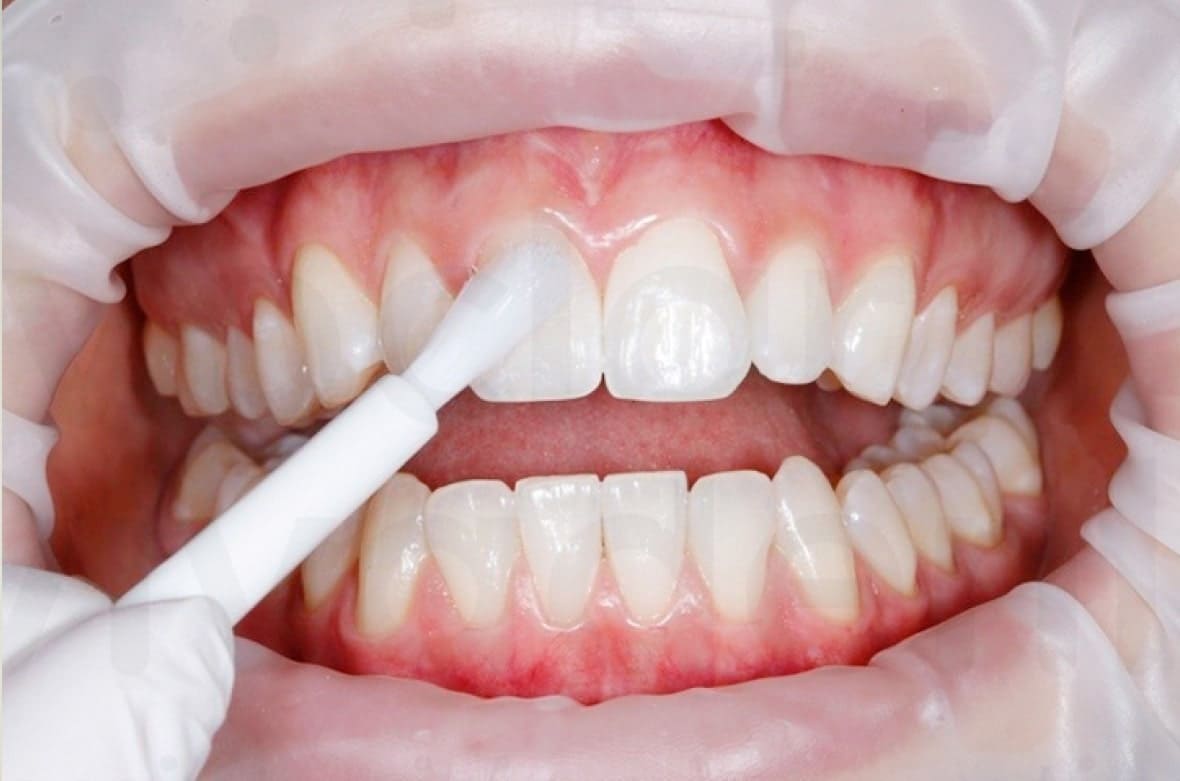 Как укрепить эмаль зубов: рекомендации стоматолога и народные средства