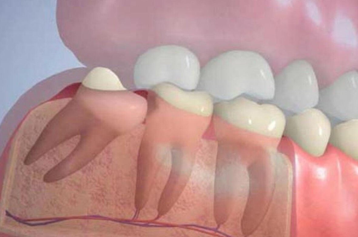 Дистопия зубов у детей и взрослых