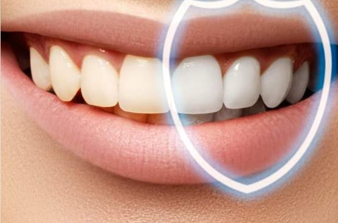 Ремінералізація зубів після відбілювання