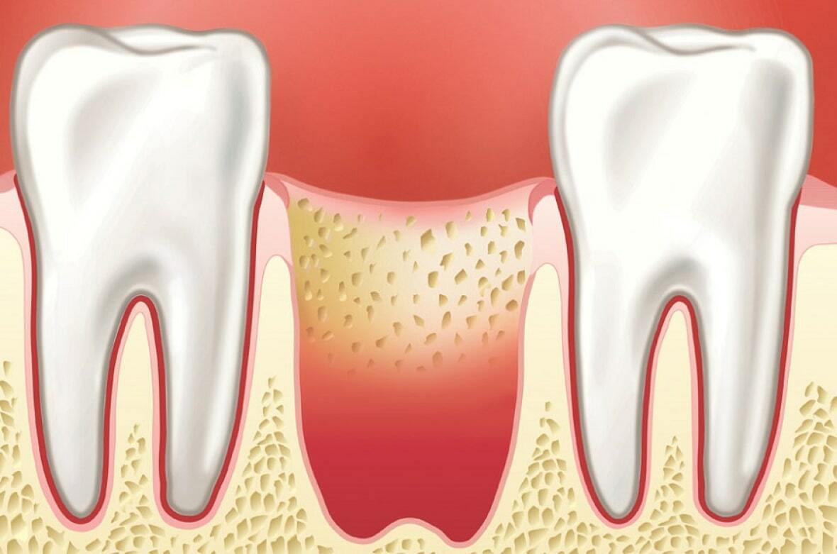 Порожня лунка після видалення зуба - лікування в домашніх умовах
