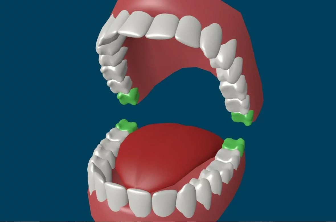 Лезет (режется) зуб мудрости: симптомы, что делать