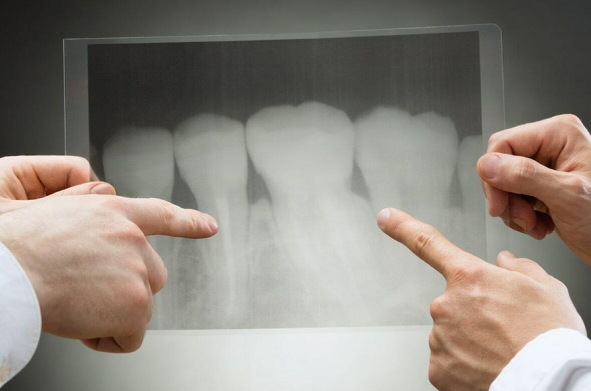 Чи можна вилікувати гранульому зуба?