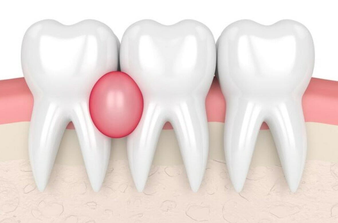 Гранульома на корені зуба - симптомиГранульома зуба перший час може ніяк не виявлятися. У рідкісних випадках під час обстеження з іншого приводу виявляється гранульома зуба на рентгені, це можна назвати справжнім везінням, адже процес лікування в даному випадку проходить легше.  До більш специфічних симптомів гранульоми відносять:  Помірний біль при жуванні твердої їжі; Підвищення чутливості зуба до холодного та гарячого; При прогресії (гнійна гранульома) - гострий біль при жуванні, а потім і в спокої, набряк ясни, поява «горбка» на ясні в області кореня зуба, витікання гною назовні. Зубна гранульома характеризується періодами загострення і стихання запального процесу. При утворенні всередині гранульоми порожнини (кістогранульома) з'являється ризик нагноєння, появи флюсу, утворення свища на ясні та інших проблем.  Якщо Ви помітили схожі симптоми у себе або у дитини, запишіться на консультацію до стоматолога-хірурга «My Smile» в Ірпені. Ми гарантуємо швидке та ефективне усунення проблеми за лояльною ціною.