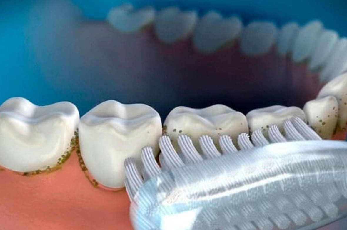 Чим небезпечні зубні камені?