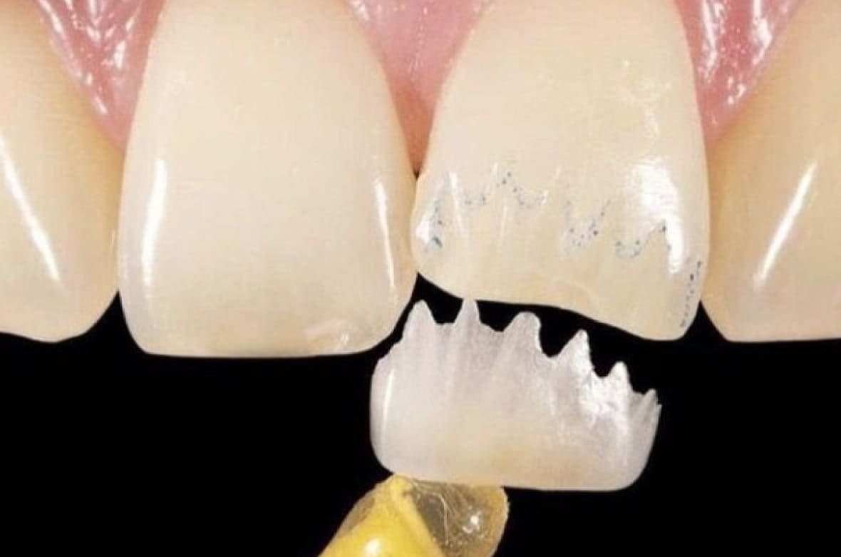 Когда требуется восстановление зуба пломбой?