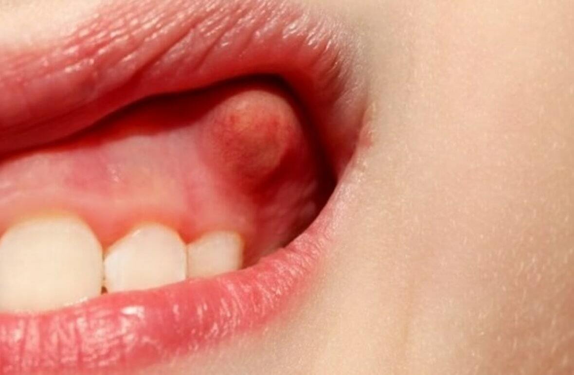 Абсцесс или гной в зубе – все о заболевании
