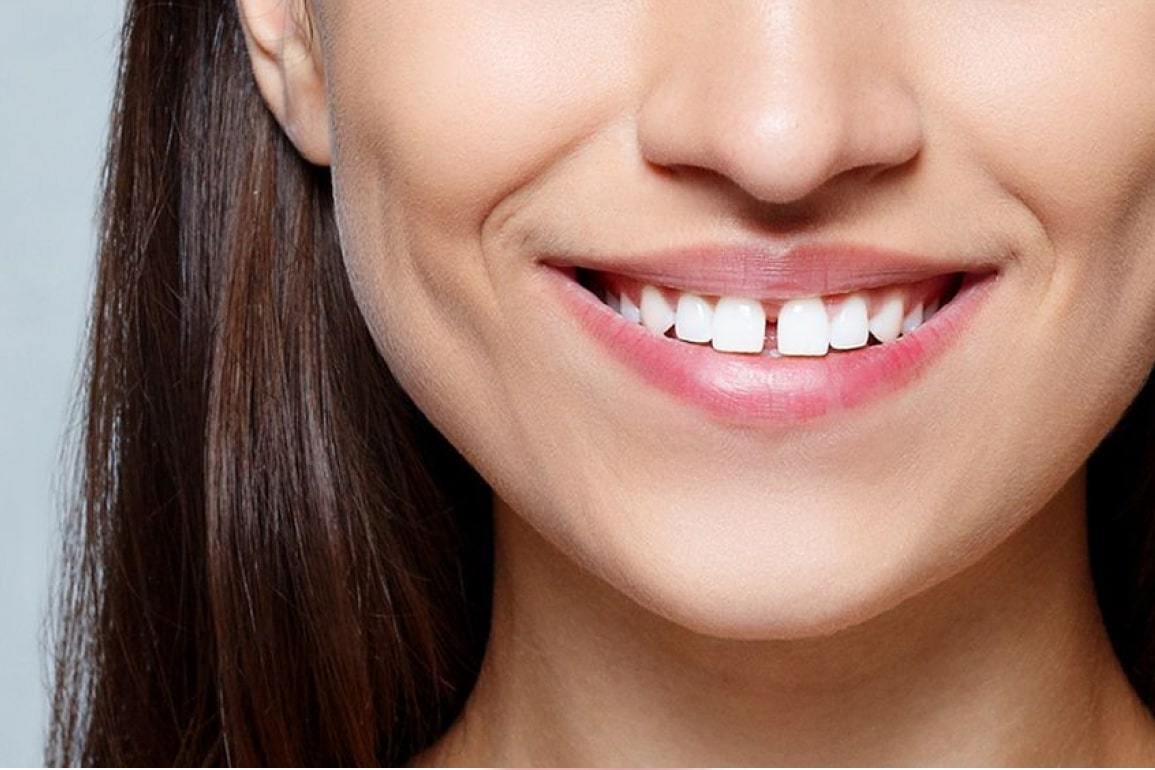 Лечение диастемы в стоматологии «My Smile»