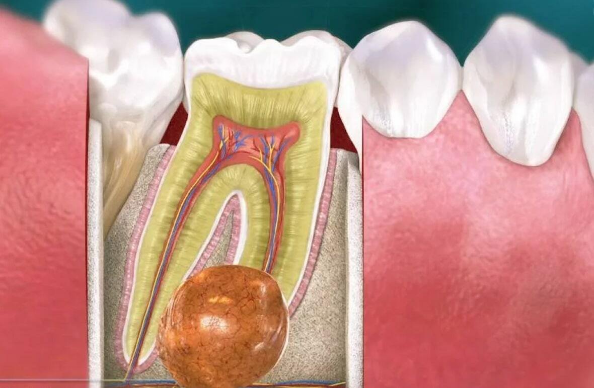 Почему появляется гной в зубе?