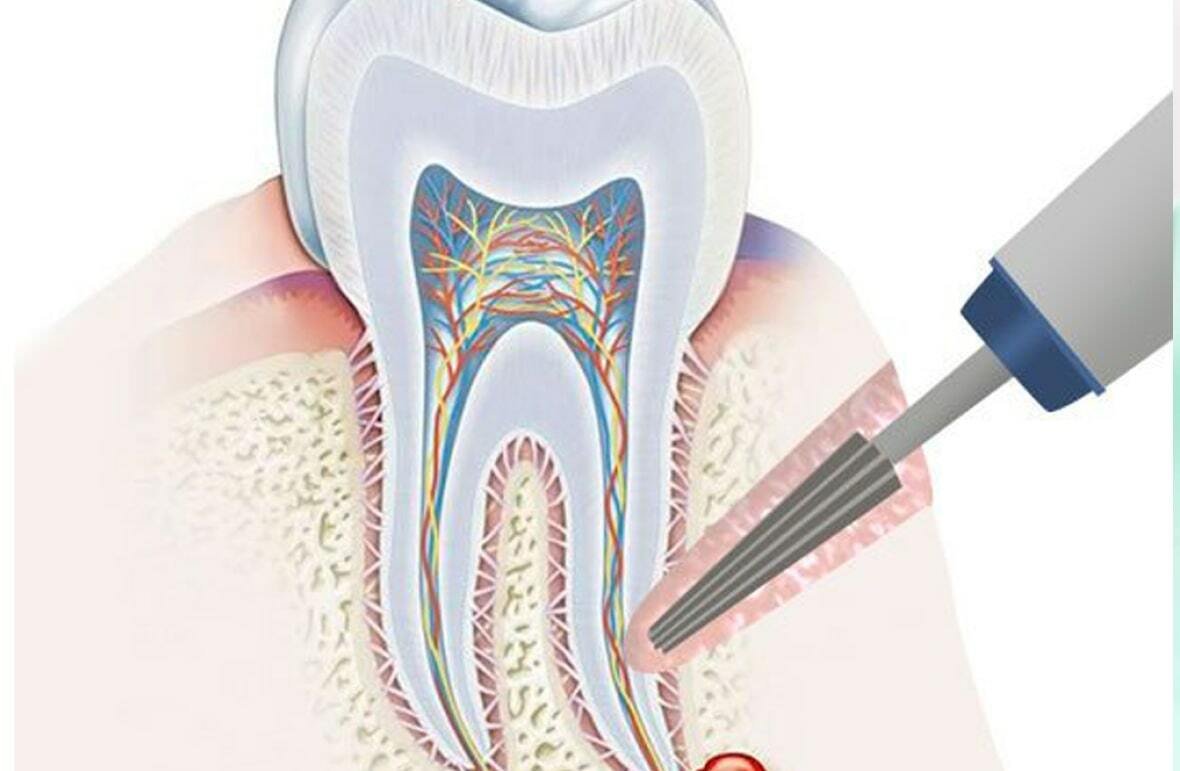 Последствия зубной кисты