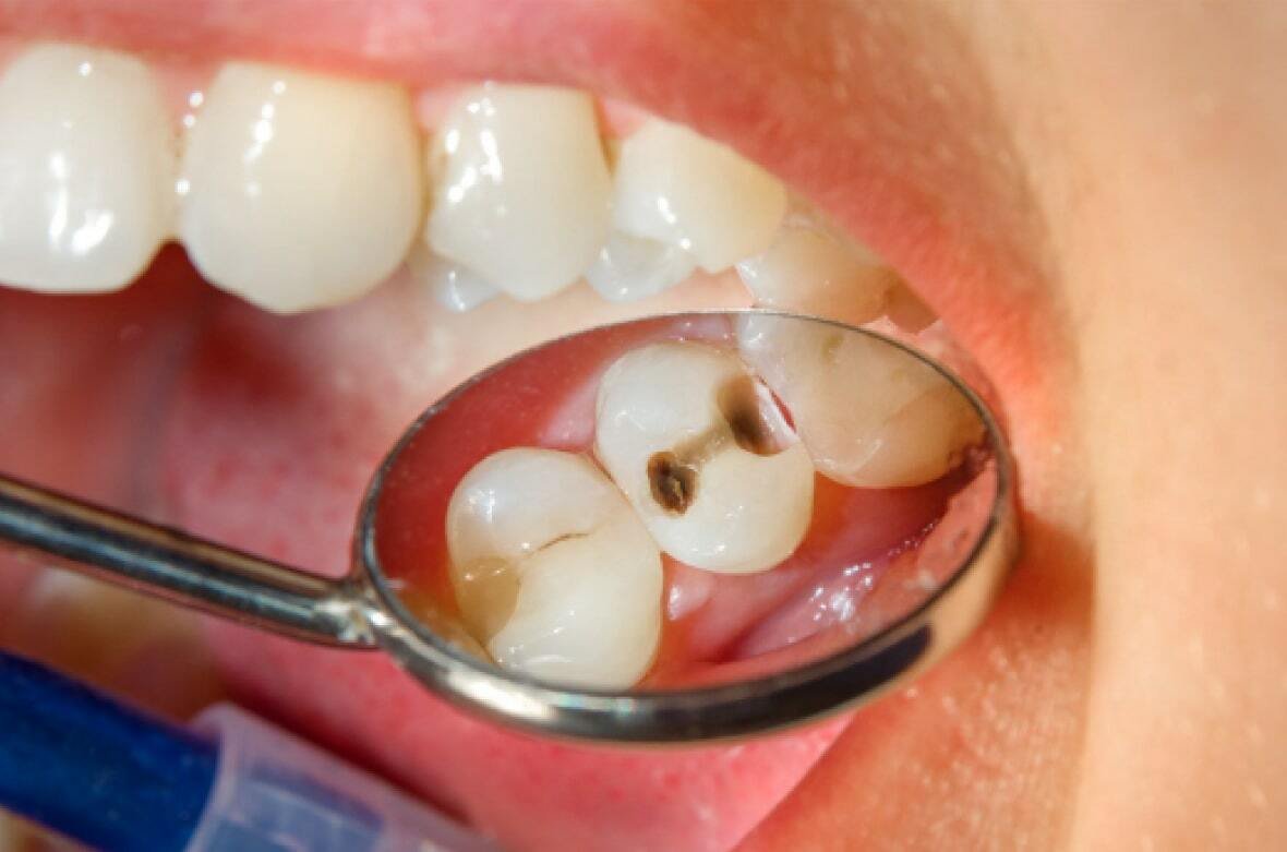 Ниє зуб після видалення нерва (ниє мертвий зуб)