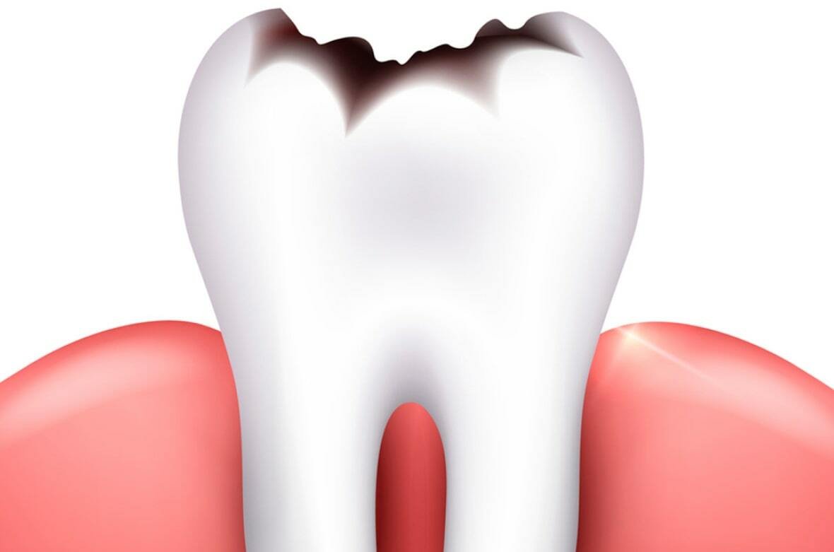 Чому злазить емаль з зубів - основні причини?
