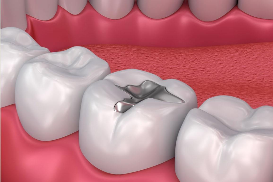 Технические ошибки стоматолога