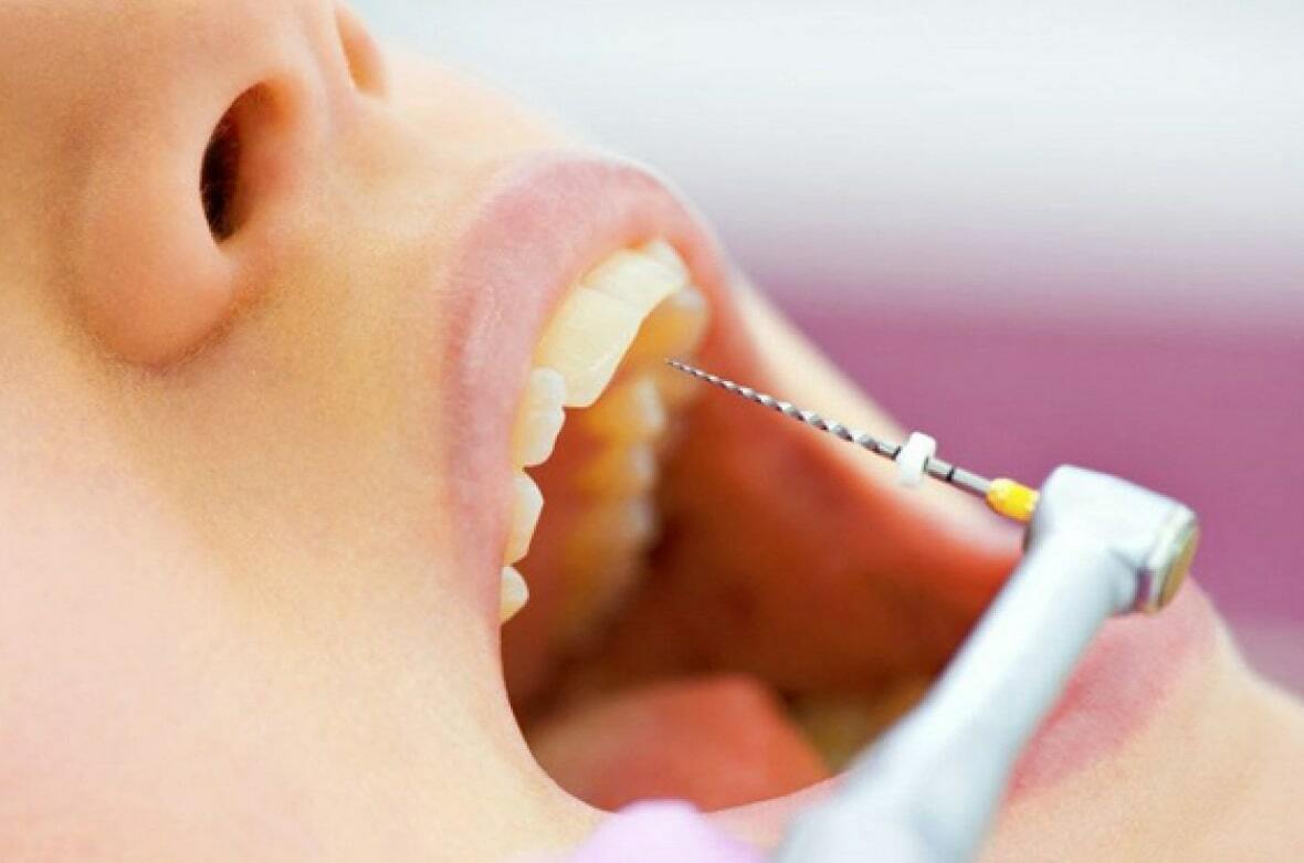 Пульсирующая боль в зубе без нерва - что делать?