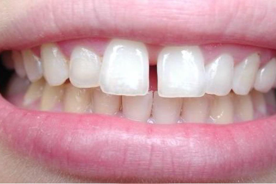 Появилась щель между зубами – нужно ли лечить?