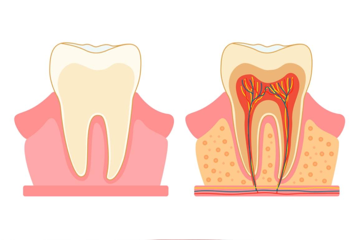 Воспаление зубного нерва (пульпит) – виды и особенности