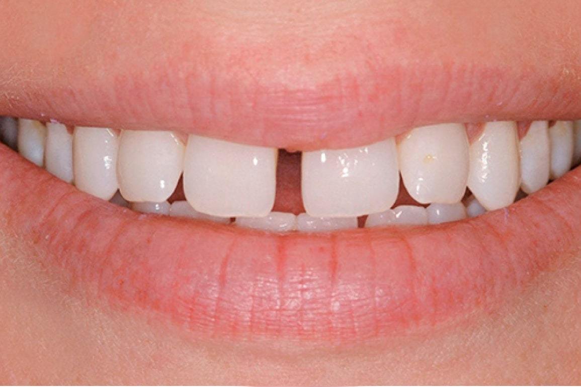 Щель между зубами или диастема