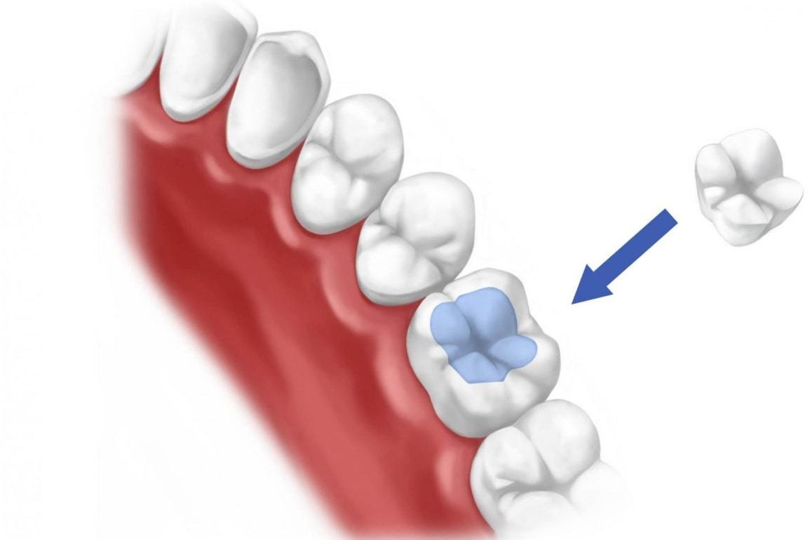 Металлическая вкладка в зуб