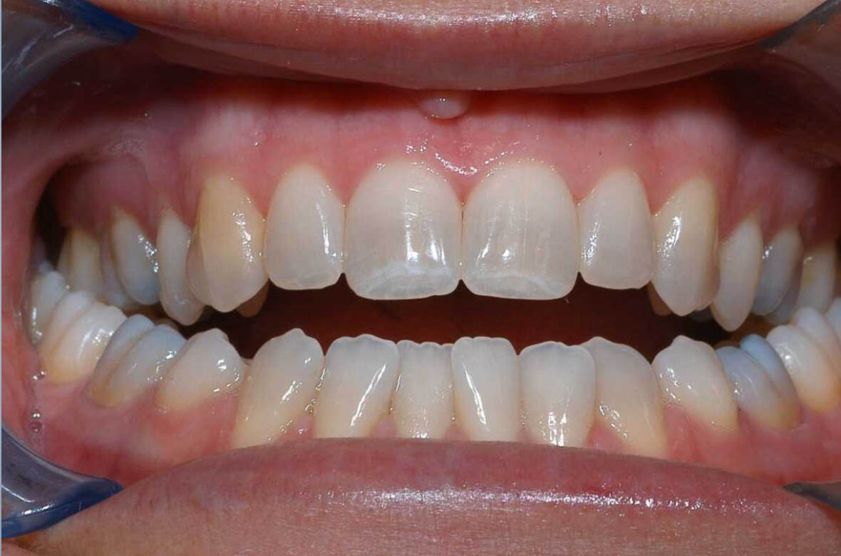 Лечение эрозии зубной эмали в My Smile