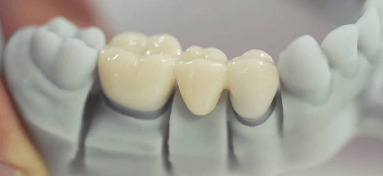 Порцелянові зуби