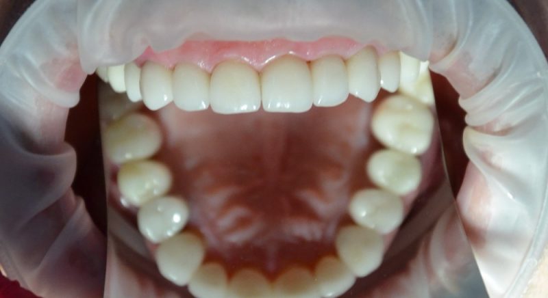 Порцелянові зуби: у чому відмінність від інших видів протезів