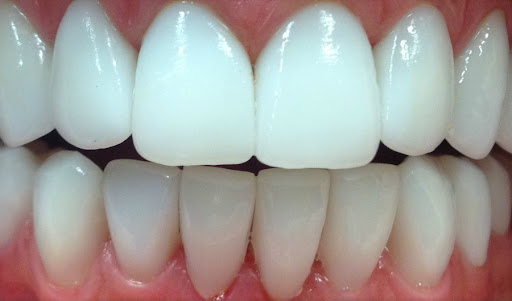 Зубы из циркония: как правильно ухаживать