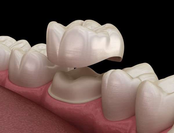 Зубные керамические коронки: противопоказания