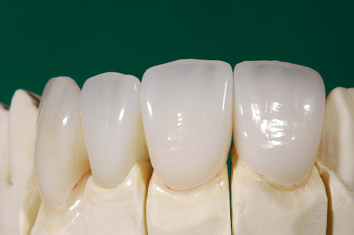 Процесс установки керамических зубов
