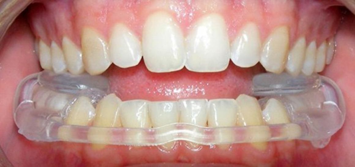 Види шинування зубів