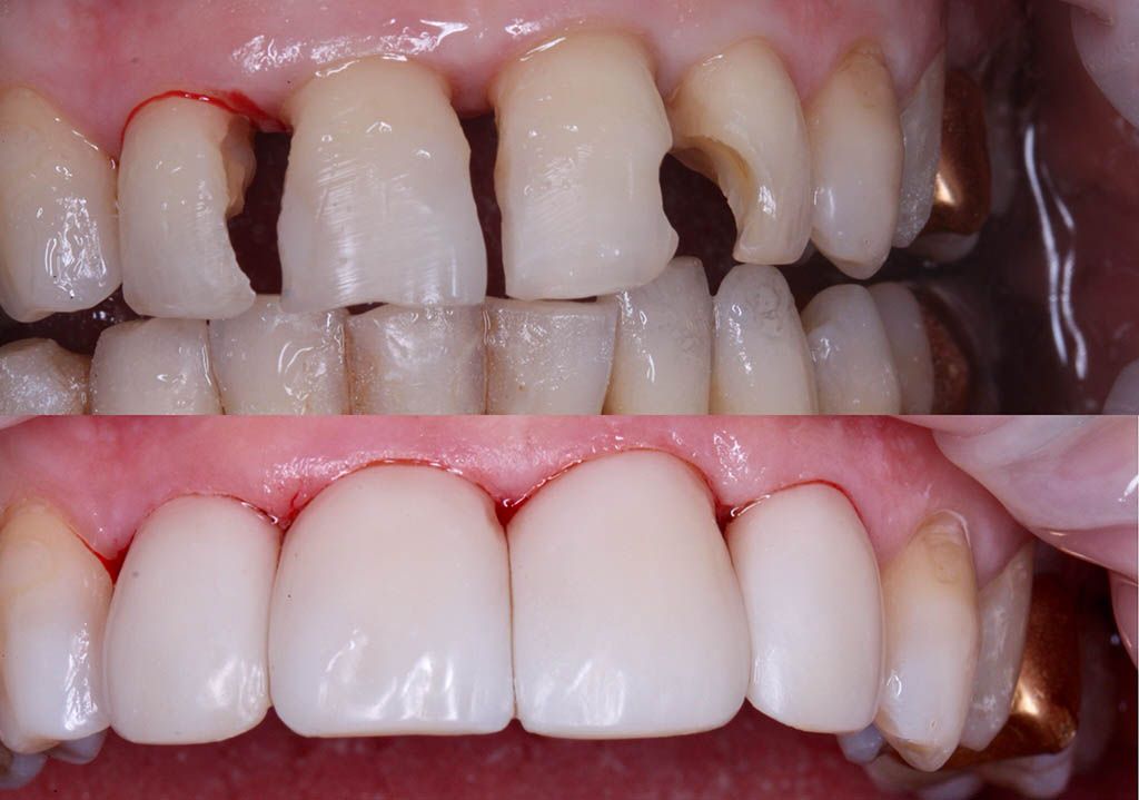 В каких случаях после лечения кариеса проводится реставрация