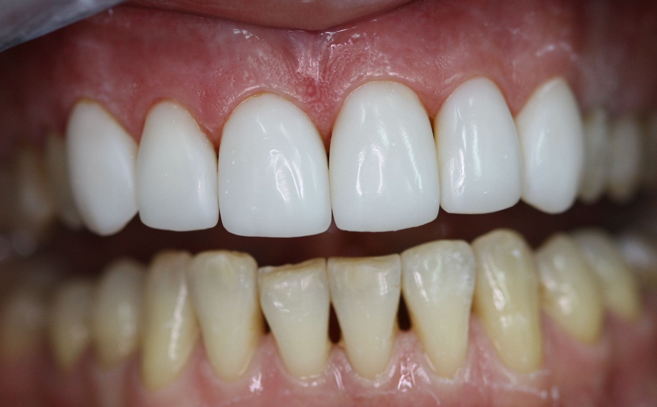 Реставрація передніх зубів в MySmile