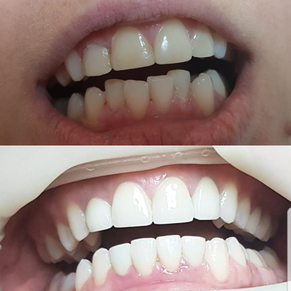 Реставрация зубов фотополимером в MySmile