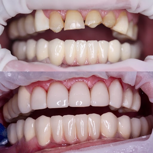 Противопоказания к реставрации передних зубов