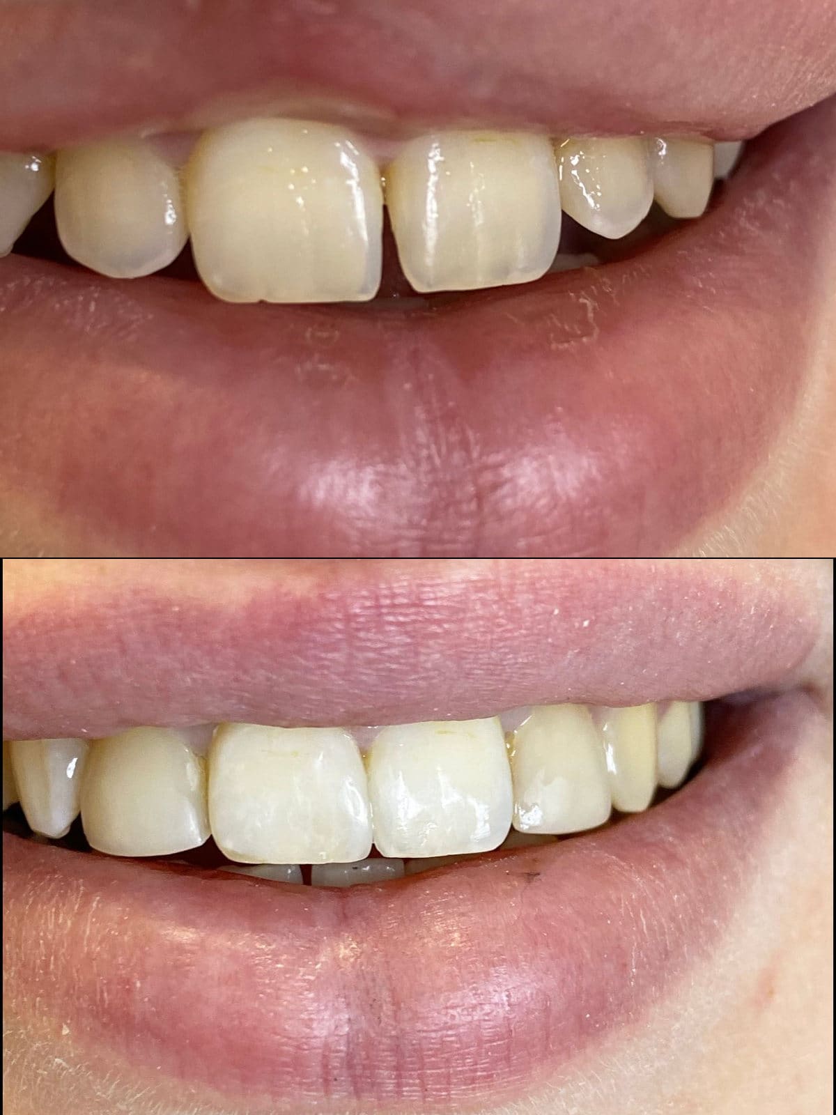 Показания к керамической реставрации зуба