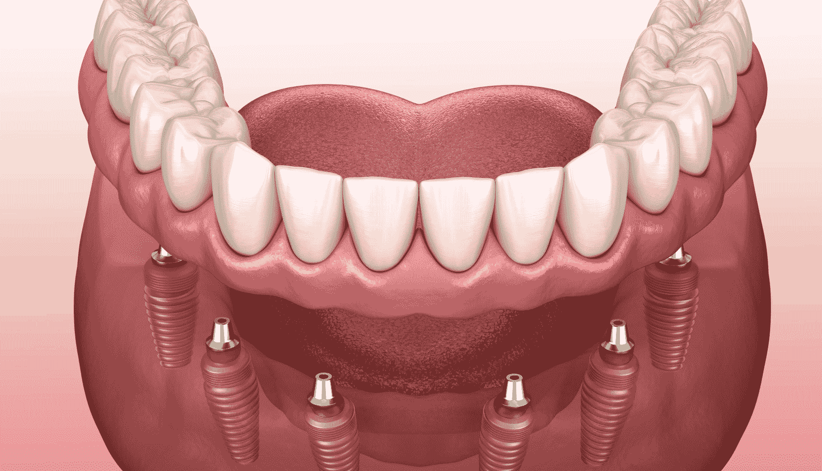 Современное протезирование зубов в My Smile