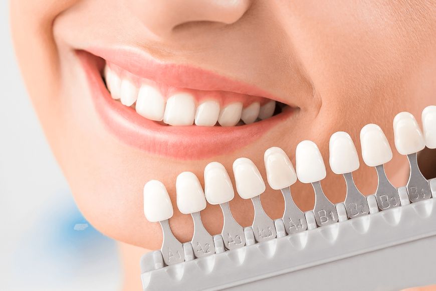 Как выполняется композитное наращивание зубов в My Smile