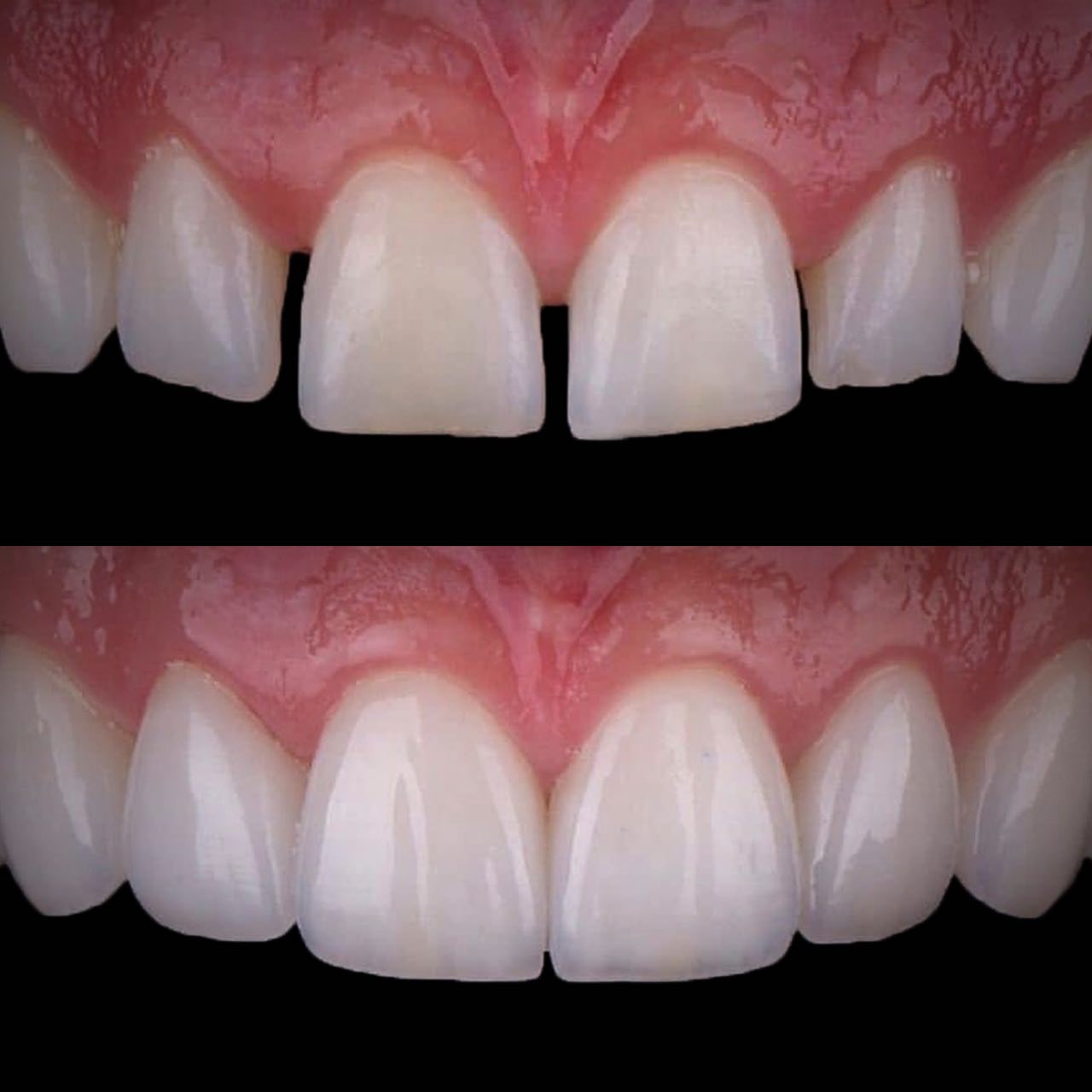 Відновлення зуба фотополімером в Ірпені