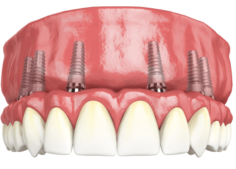 Частково-знімні зубні протези