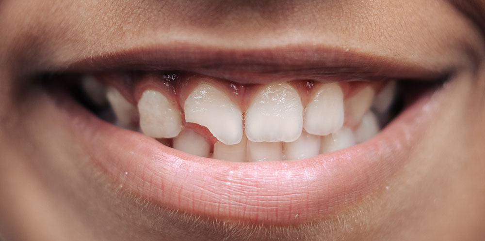 Почему так важен своевременный ремонт скола зуба