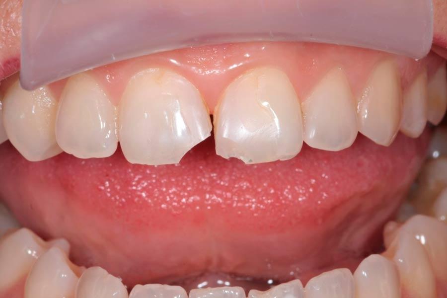 Лечение скола зуба в клинике 