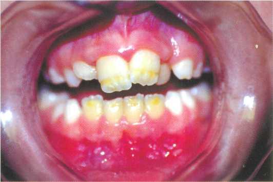 Лікування мармурової хвороби зубів в клініці 