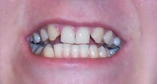 Чому виникає адентія зубів і якою вона буває