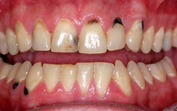 Мраморные зубы: симптомы и диагностика