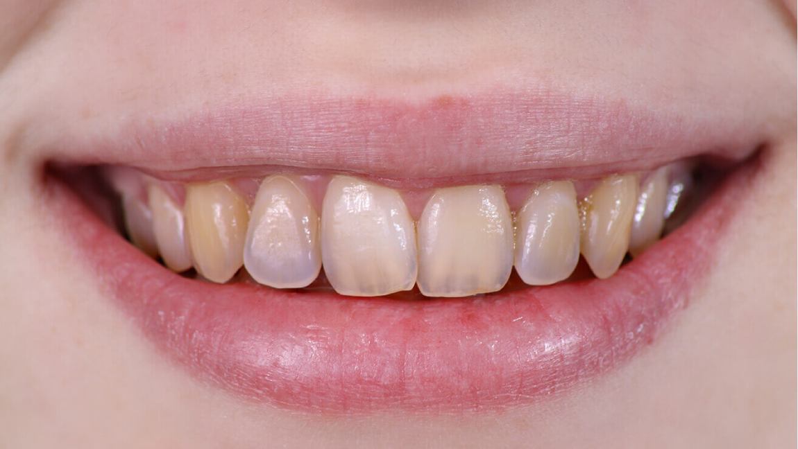 Причини та лікування некаріозних уражень зубів